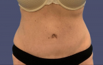 Abdominoplasty (Tummy Tuck) 10 After